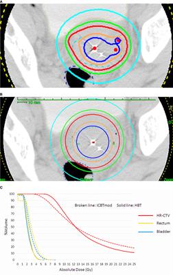 Frontiers Combined Interstitial And Intracavitary High Dose Rate Brachytherapy Of Cervical Cancer